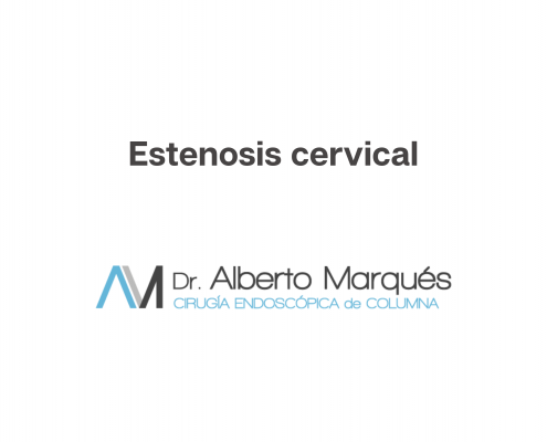 estenosis de canal cervical