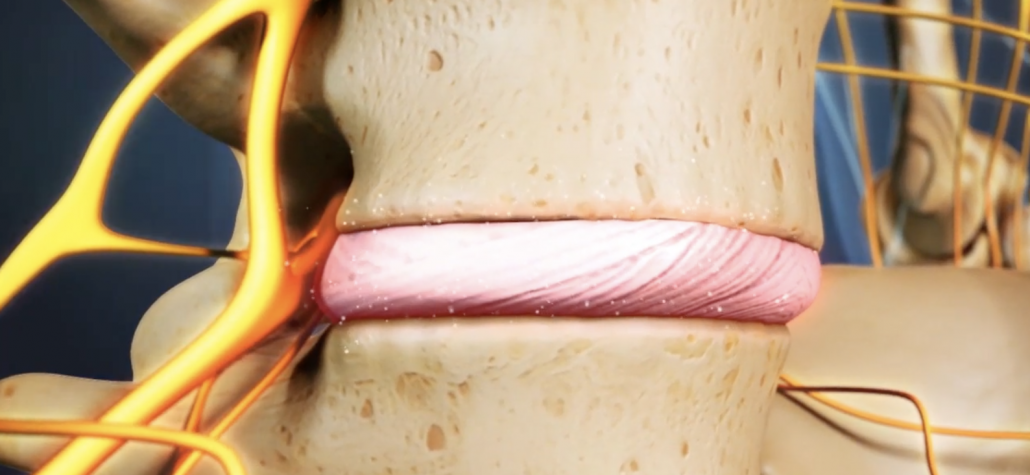 inestabilidad lumbar