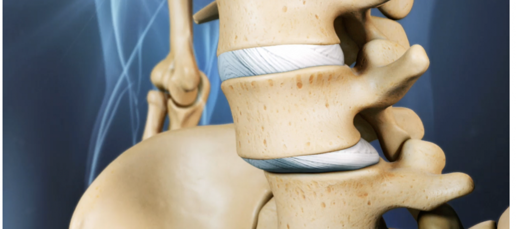 inestabilidad lumbar