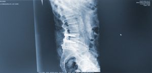 Cirugia avanzada de cloumna