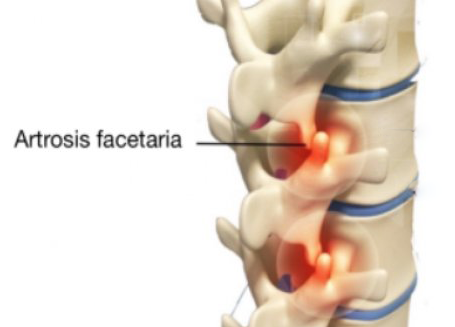 Artrosis facetaria