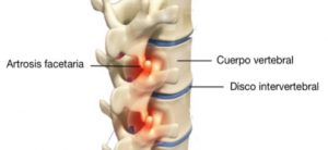 Artrosis facetaria