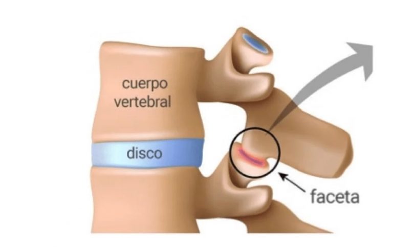 artrosis facetaria
