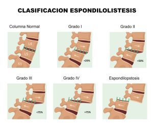 Espondolistesis