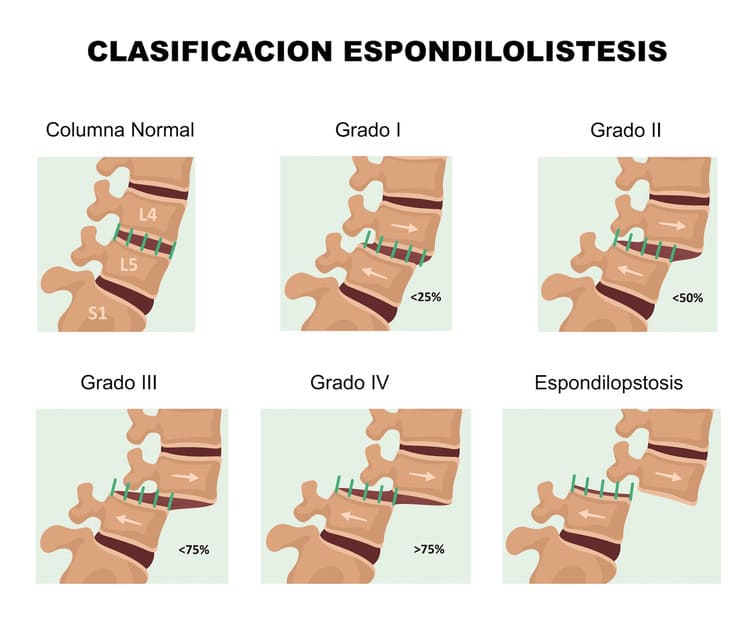 Espondolistesis