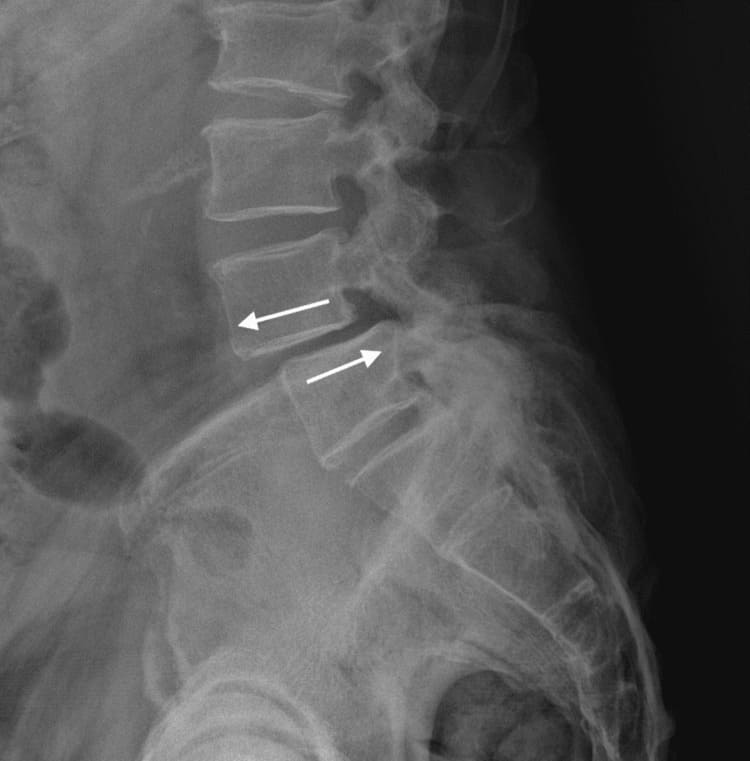 espondilolistesis